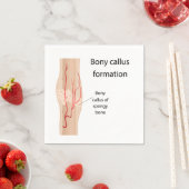 Bildung von Bony callus Serviette (Beispiel)