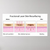 Blasenhaut mit Bruchkerbe Poster (Vorne)