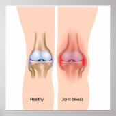 Blutungen in Hämophilie Poster (Vorne)