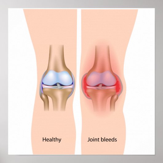 Blutungen in Hämophilie Poster (Vorne)