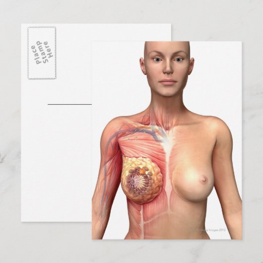 Brustkrebs Postkarte (Vorne/Hinten)