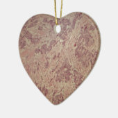 Brustkrebs unter dem Mikroskop Keramikornament (Links)