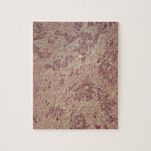 Brustkrebs unter dem Mikroskop Puzzle (Vertikal)