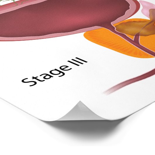 Bühnen von Prostatakrebs Poster (Ecke)