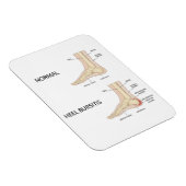 Bursitis calcanea magnet (Rechte Seite)