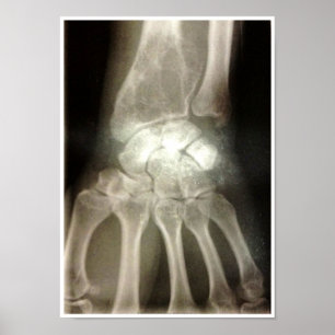 Carpals Xray Poster