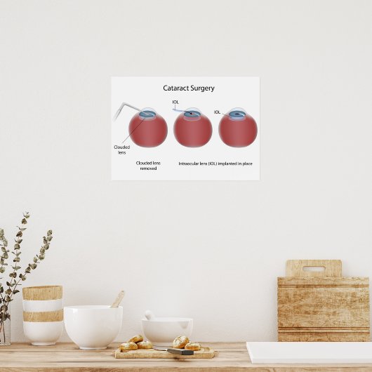 Cataract Operation Poster (Küche)