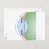 Cataract-Operation Postkarte (Vorne/Hinten)