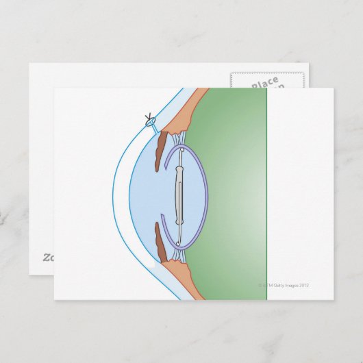 Cataract-Operation Postkarte (Vorne/Hinten)