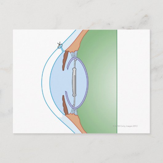 Cataract-Operation Postkarte (Vorderseite)