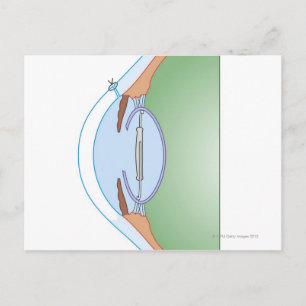 Cataract-Operation Postkarte
