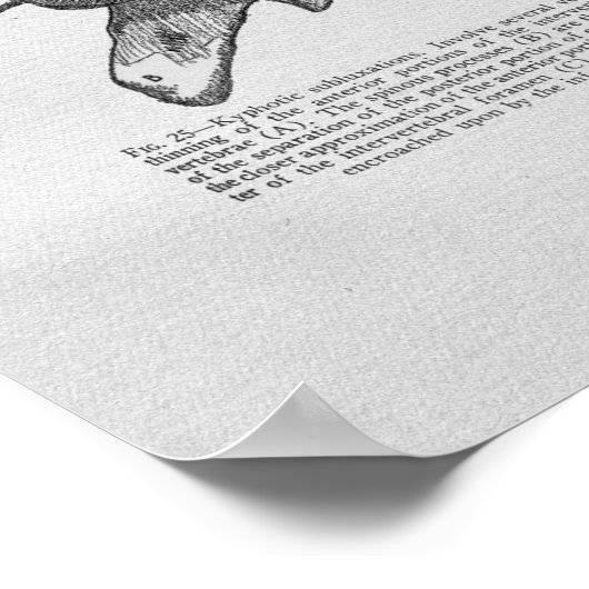 Chiropractic Subluxation Vintag Print Poster (Ecke)