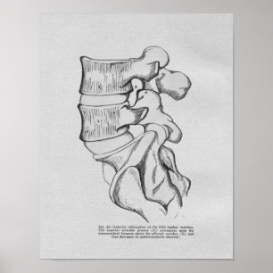 Chiropraktische vertebrale Subluxation Vintag Prin Poster