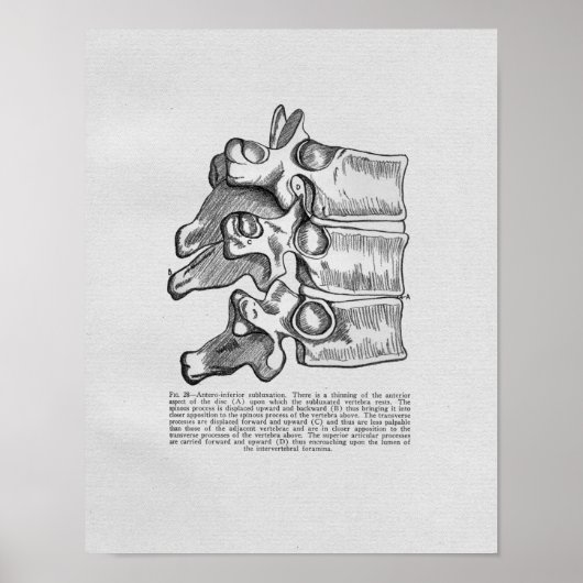Chiropraktische vertebrale Subluxation Vintag Prin Poster (Vorne)