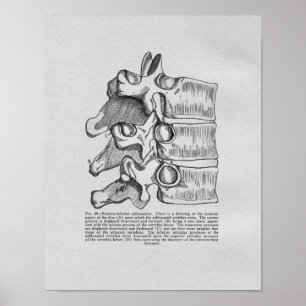 Chiropraktische Wirbelsubluxation Vintage-Druck Poster