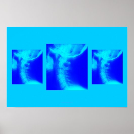 Chiropraktisches Poster: Laterale zervikale Blues Poster (Vorne)
