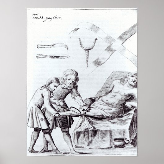 Chirurgische Operation zur Amputation eines Beins Poster (Vorne)