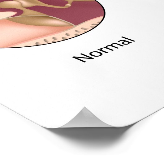 Cholesteatom Mittelohrtumor Poster (Ecke)