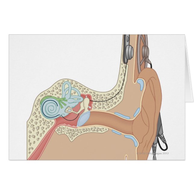 Cochlear Implantate (Vorderseite (Horizontal))