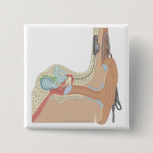 Cochlear Implantate Button (Vorderseite)