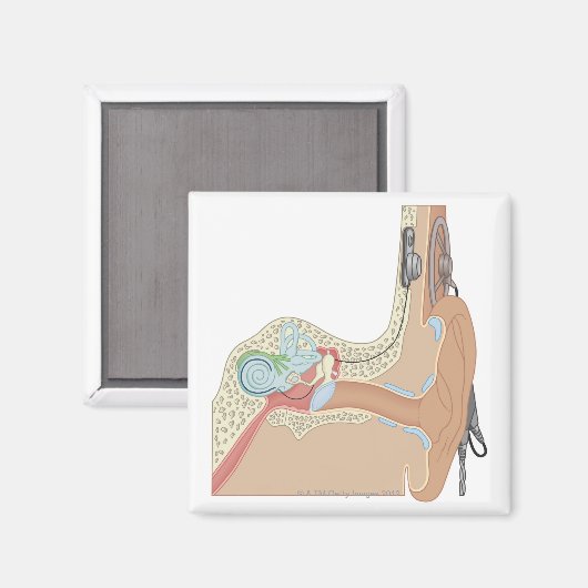 Cochlear Implantate Magnet (Vorderseite/Rückseite)