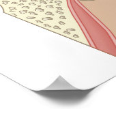 Cochlear Implantate Poster (Ecke)