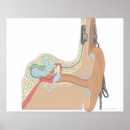 Cochlear Implantate Poster (Vorne)