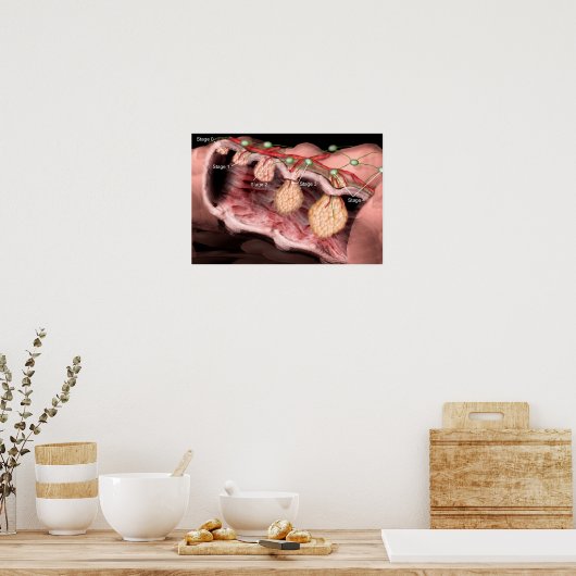 Colon-Krebs-Poster Poster (Küche)