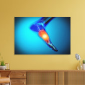 Conceptual Image of Pain in Human Foot Leinwanddruck (Insitu (Wohnzimmer))