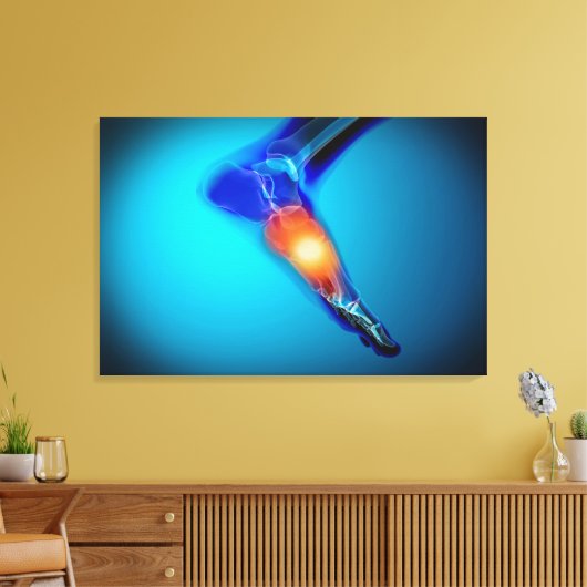 Conceptual Image of Pain in Human Foot Leinwanddruck (Insitu (Wohnzimmer))