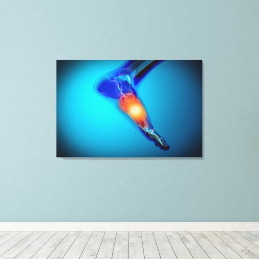 Conceptual Image of Pain in Human Foot Leinwanddruck (Insitu (Holzboden))