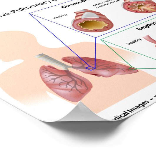 COPD Lung Disease Diagramm Poster (Ecke)