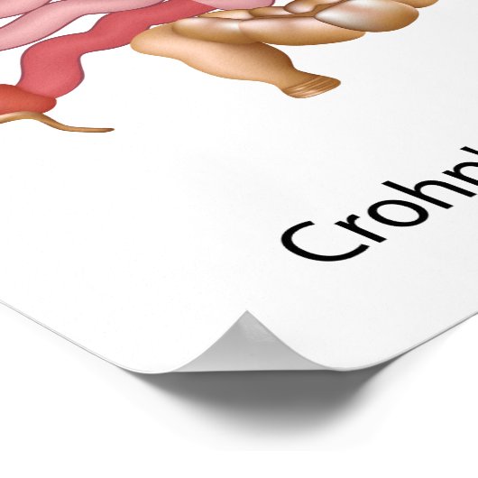 Darmerkrankung (ibd) poster (Ecke)