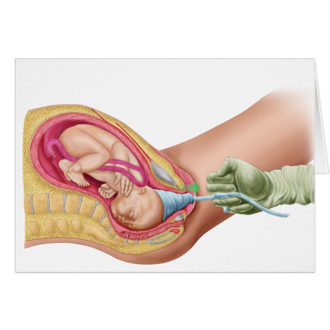 Darstellung der Lieferung von Fetus 1 (Vorderseite (Horizontal))