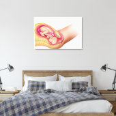 Darstellung der Lieferung von Fetus 2 Leinwanddruck (Insitu (Schlafzimmer))