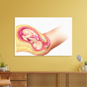 Darstellung der Lieferung von Fetus 2 Leinwanddruck (Insitu (Wohnzimmer))