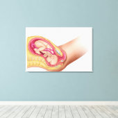 Darstellung der Lieferung von Fetus 2 Leinwanddruck (Insitu (Holzboden))