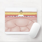 Darstellung einer Hernie Mousepad (Mit Mouse)