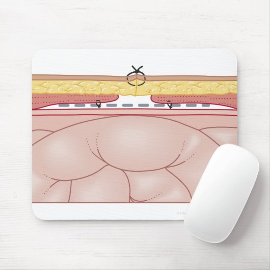 Darstellung einer Hernie Mousepad (Mit Mouse)