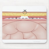 Darstellung einer Hernie Mousepad (Vorne)