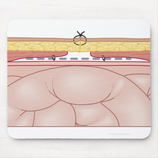 Darstellung einer Hernie Mousepad (Vorne)