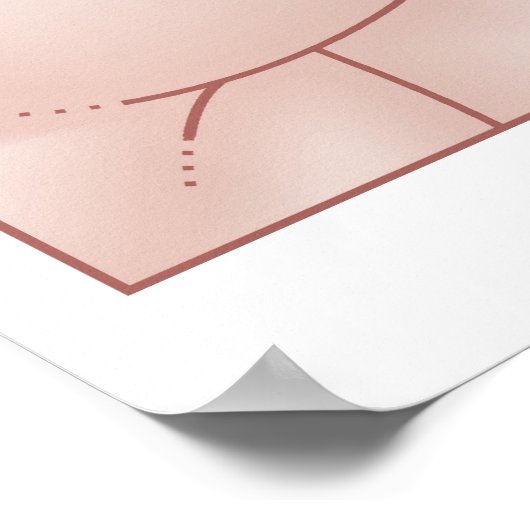 Darstellung einer Hernie Poster (Ecke)