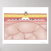 Darstellung einer Hernie Poster (Vorne)