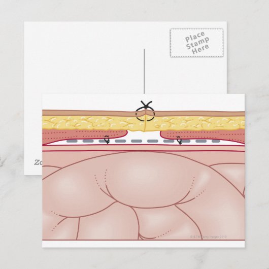 Darstellung einer Hernie Postkarte (Vorne/Hinten)