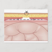 Darstellung einer Hernie Postkarte (Vorderseite)