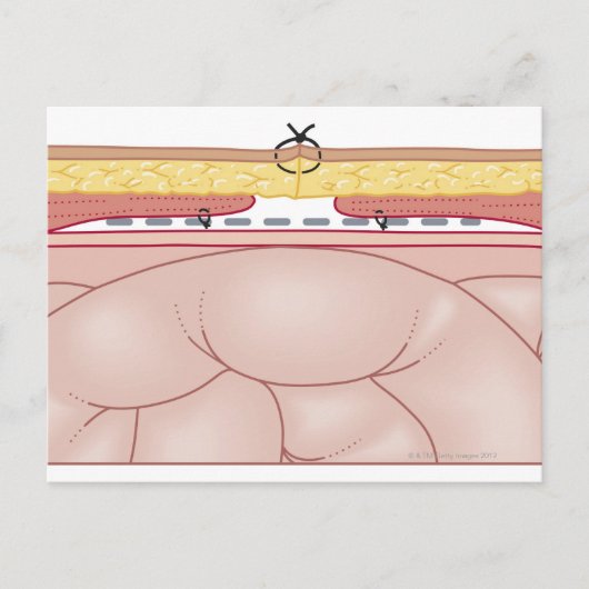 Darstellung einer Hernie Postkarte (Vorderseite)