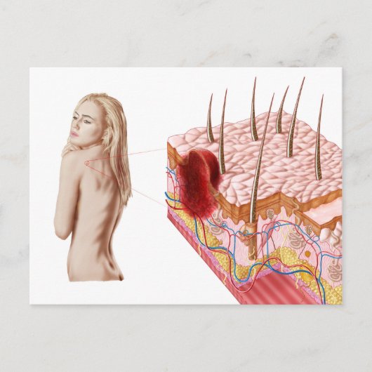 Darstellung eines atypischen Hautwachstums Postkarte (Vorderseite)