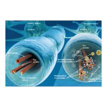 Desintegration der Mikrotubuli in einem Neuron