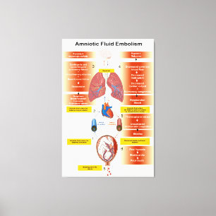 Diagramm eines Nachwasser-Embolismus AFE Leinwanddruck