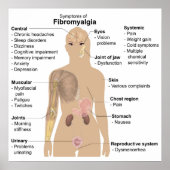 Diagramm Gemeinsame Anzeichen + Symptome Fibromyal Poster (Vorne)